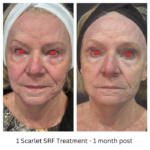 Key Benefits of Scarlet RF Treatment: A Complete Guide