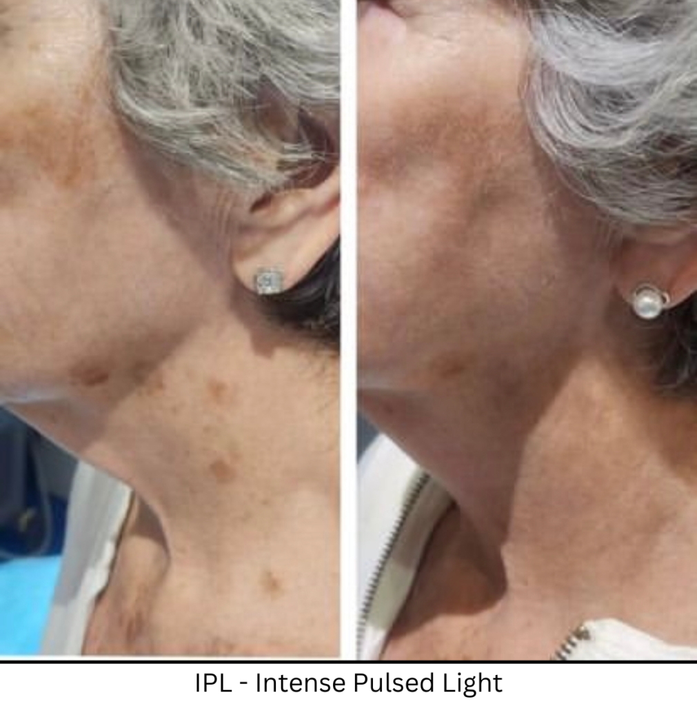 IPL - Intense Pulsed Light