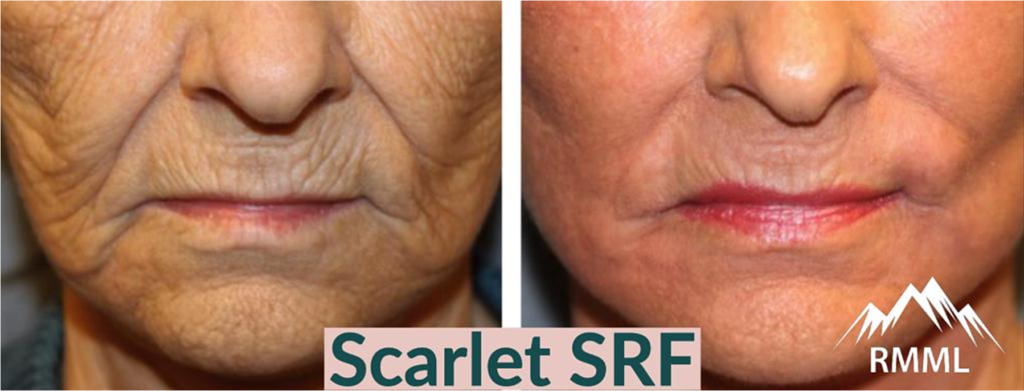 Scarlet SRF BEFORE & AFTER