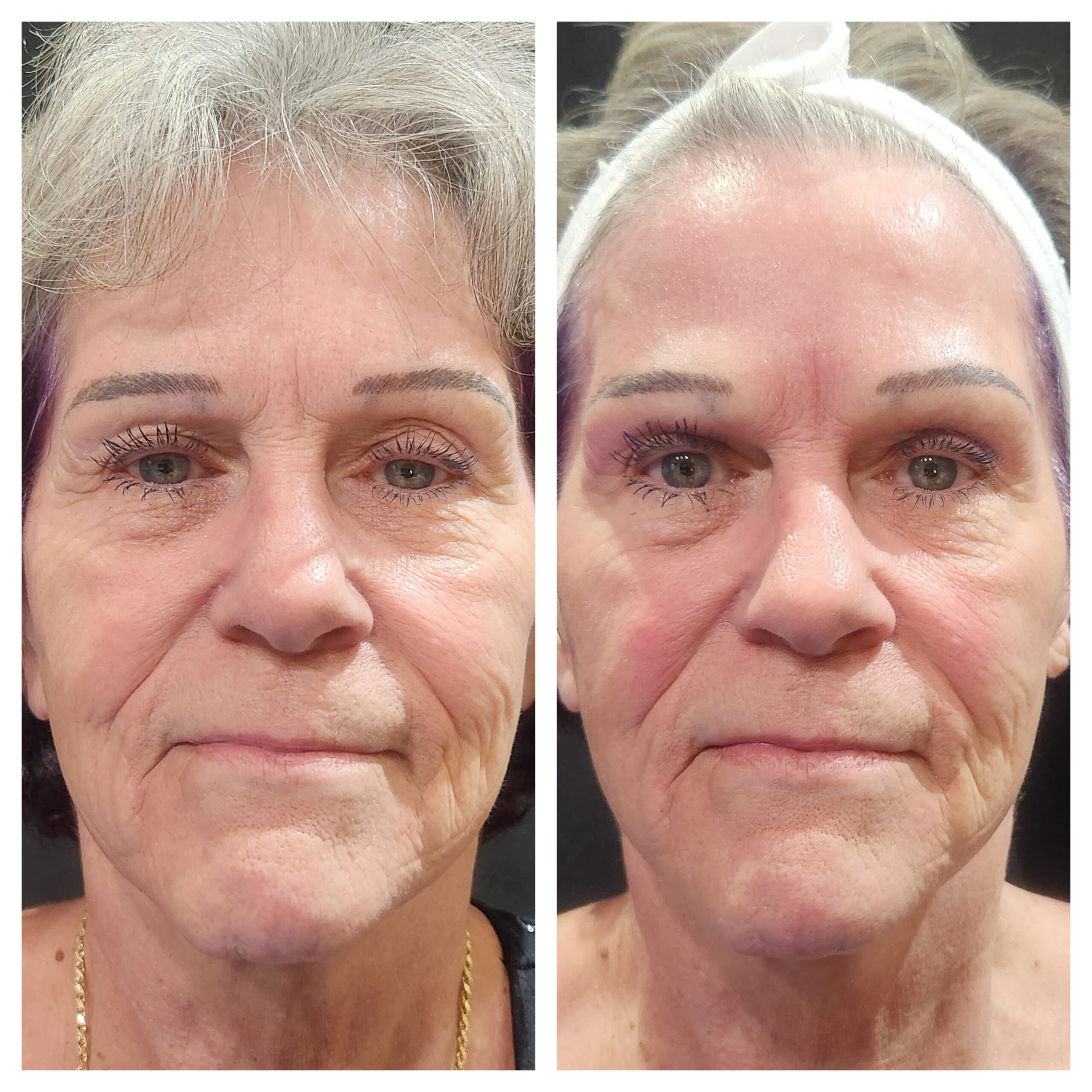 RF Microneedling for Eyebrow Lift with Upper Eyelid & Forehead Skin Tightening in Prescott, AZ