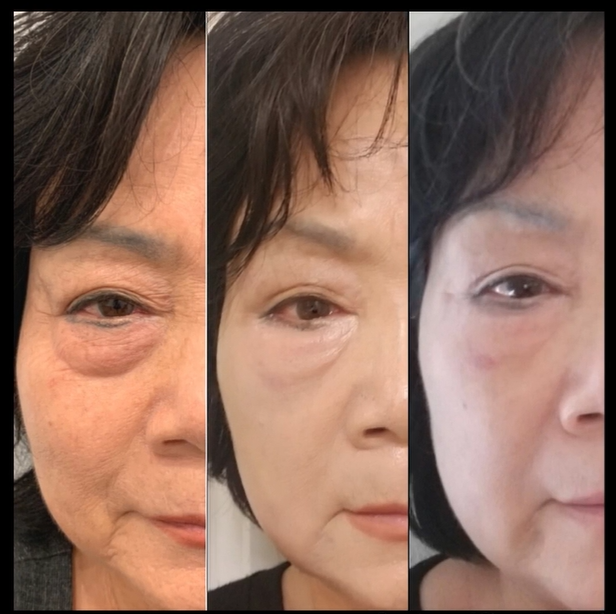 Before and After RF Microneedling for Agnes Fat Pad Reduction in Prescott, AZ