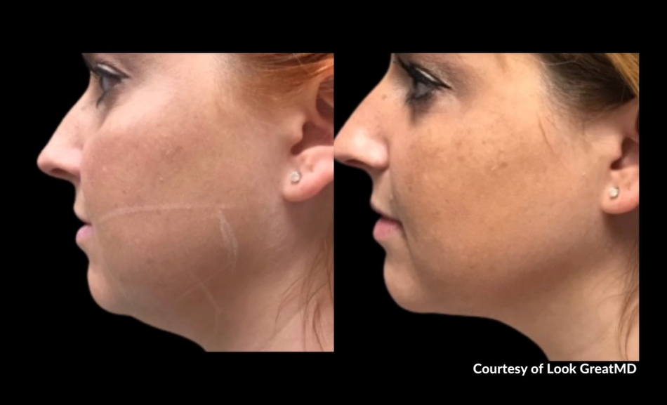 Before and After RF Microneedling for Agnes Lower face sculpting in Prescott, AZ