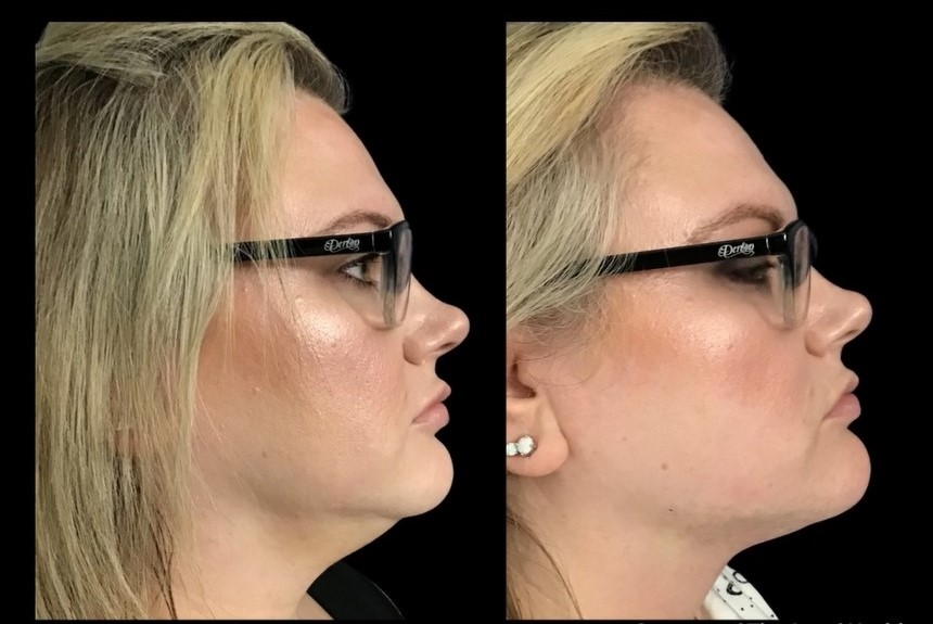 Before and After Agnes RF Microneedling for Agnes Submental Fat Reduction in Prescott, AZ