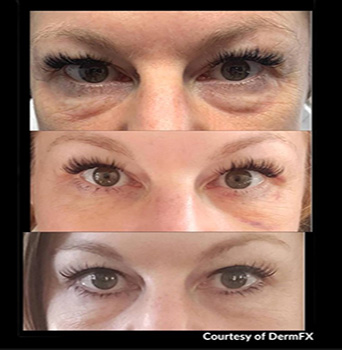 Before and After RF Microneedling Agnes Undereye Fat Pad Reduction with skin tightening in Prescott, AZ