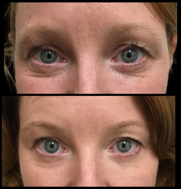 Before and After Agnes RF Microneedling Undereye Skin Tightening in Prescott AZ