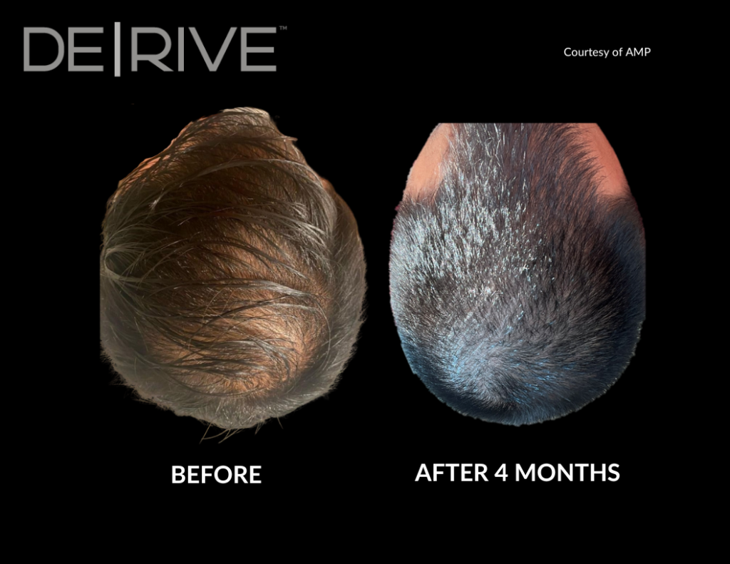 derive hair restoration​ | non surgical hair regrowth treatment​