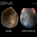 No Surgery Required: How De|Rive is Changing Hair Restoration