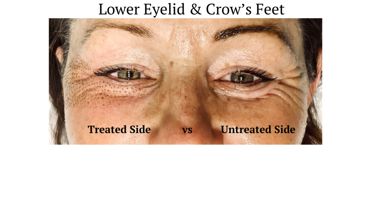 plasmage before and after