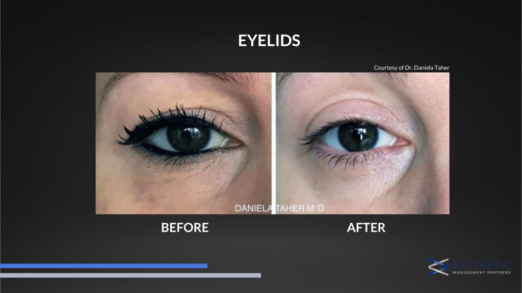 Hooded Eyelid Treatments