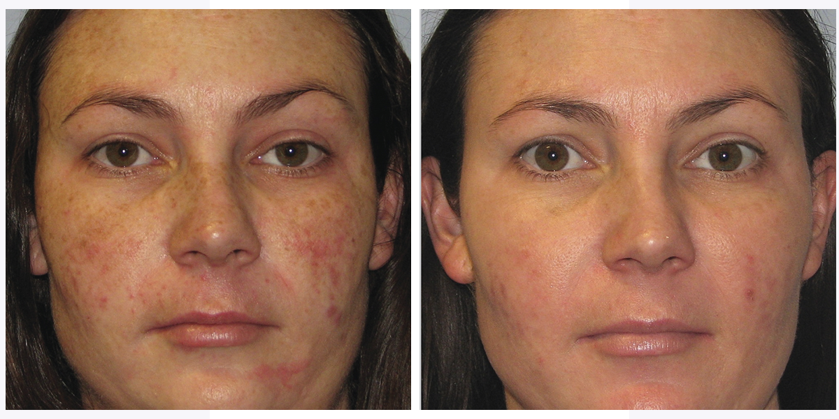 IPL before and after example showing improvement in visible redness and uneven tone