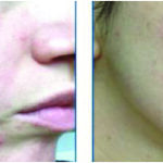 Understanding Rosacea: How IPL Treatment Can Help Manage Your Symptoms