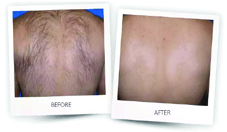 Laser Hair Removal Prescott AZ - Freya's Laser Med Spa