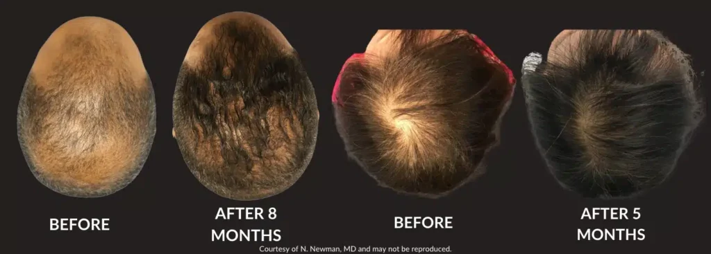 derive hair restoration - best non surgical hair growth treatment
