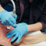 Agnes RF for Jowls: Lifting and Sculpting a Sagging Jawline
