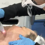 What Is Plasma Skin Tightening?