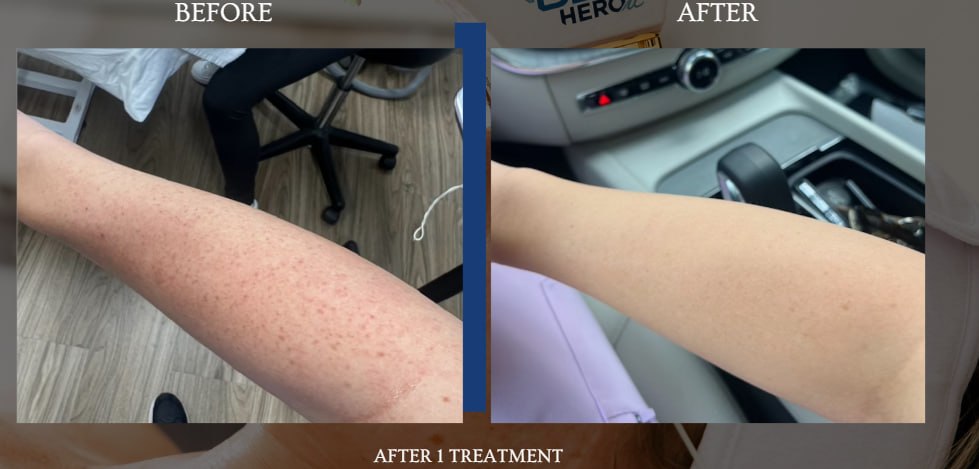 BBL HEROic arm before and after example after one treatment
