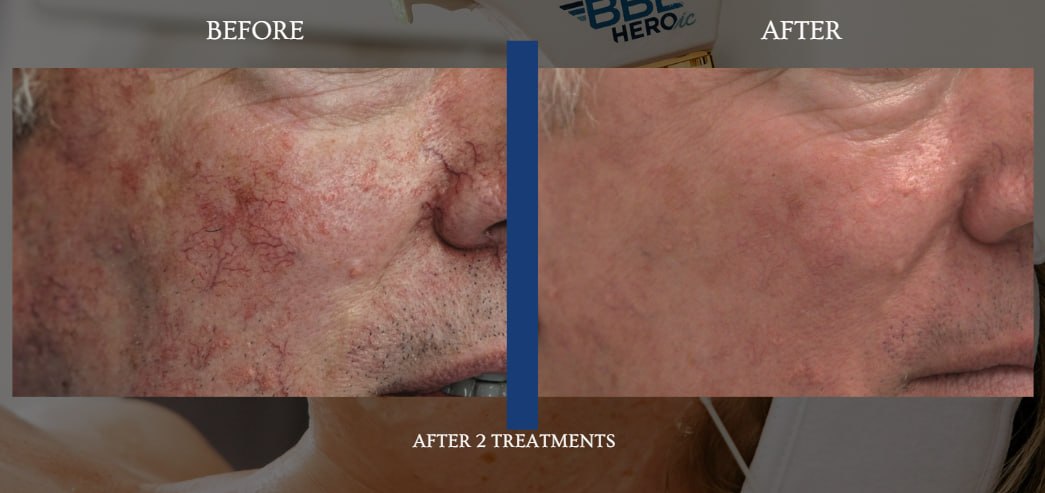 BBL HEROic before and after example after two treatments