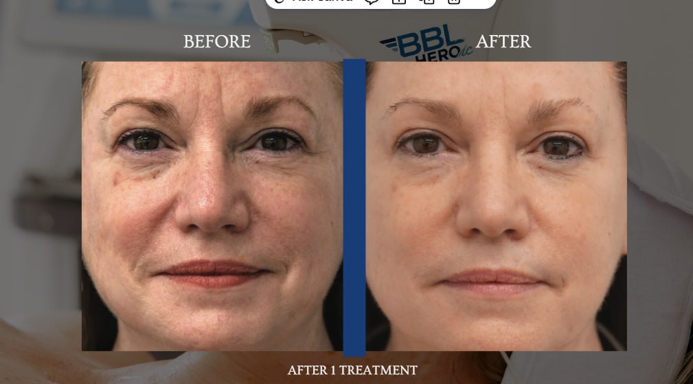 BBL HEROic facial before and after example after one treatment
